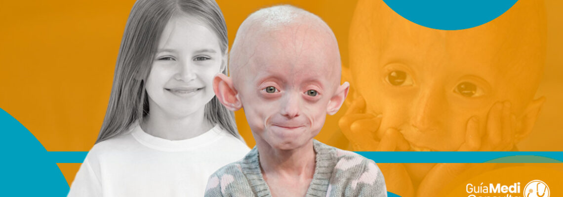 Síndrome de Hutchinson-Gilford (Progeria)