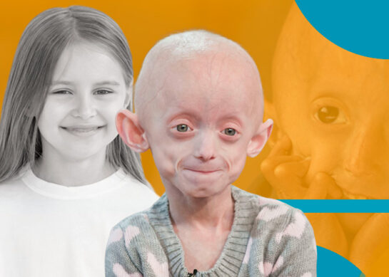 Síndrome de Hutchinson-Gilford (Progeria)